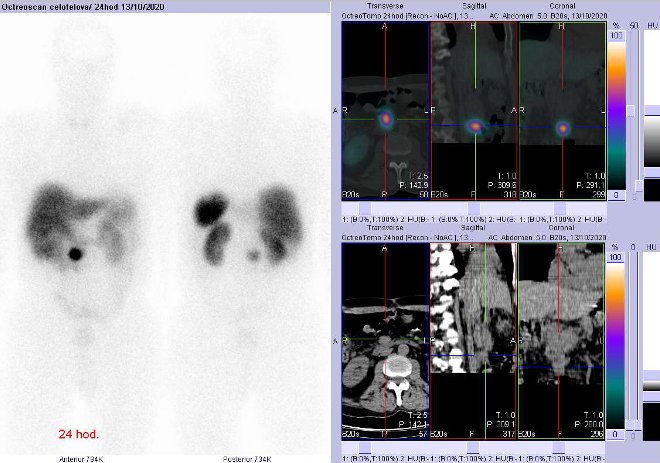 Obr. č. 4: Celotělová scintigrafie a fúze obrazů SPECT a CT – vyšetření břicha a pánve 24 hod. po aplikaci radiofarmaka. Zaměřeno na ložisko v břiše pod hlavou pankreatu v úrovni úseku D3 duodena velikosti 23x14 mm.
