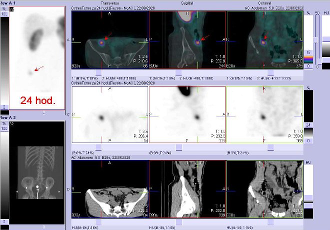 Obr. č. 2: Fúze obrazů SPECT a CT – vyšetření břicha a pánve 24 hod. po aplikaci radiofarmaka. Zaměřeno na ložisko v břiše v céku.