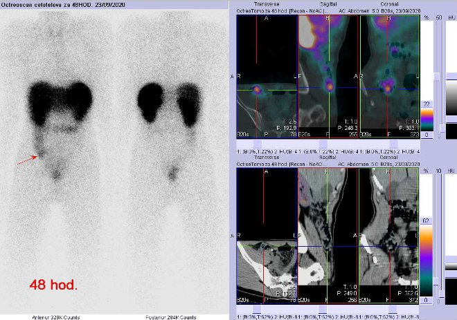 Obr. č. 3: Celotělová scintigrafie a fúze obrazů SPECT a CT – vyšetření břicha a pánve 48 hod. po aplikaci radiofarmaka. Zaměřeno na ložisko v břiše v céku.