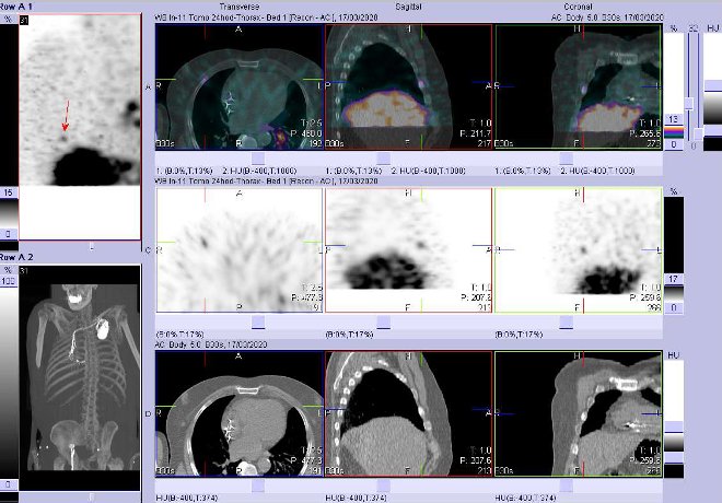 Obr. č. 10: Fúze obrazů SPECT a CT – vyšetření 24 hod. po aplikaci radiofarmaka. Zaměřeno na ložisko ve ventrální části jednoho žebra vpravo.