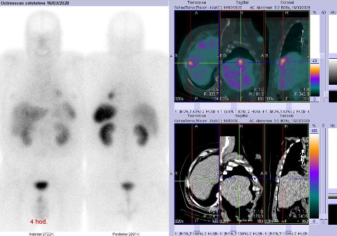 Obr. č. 4: Celotělová scintigrafie a fúze obrazů SPECT a CT – vyšetření 4 hod. po aplikaci radiofarmaka. Zaměřeno na ložisko v pravém jaterním laloku.