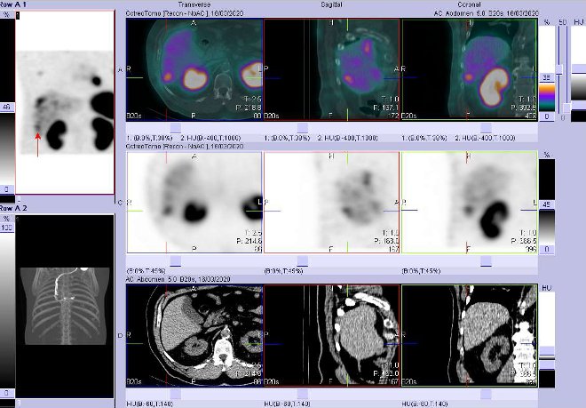 Obr. č. 6: Fúze obrazů SPECT a CT – vyšetření 4 hod. po aplikaci radiofarmaka. Zaměřeno na ložisko v pravém jaterním laloku.