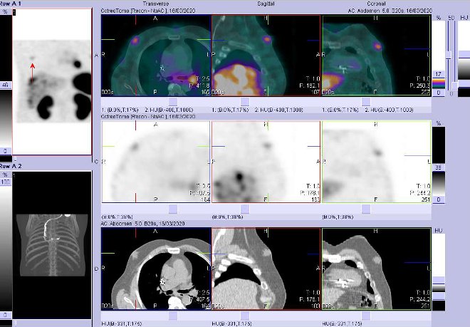 Obr. č. 7: Fúze obrazů SPECT a CT – vyšetření 4 hod. po aplikaci radiofarmaka. Zaměřeno na ložisko zřejmě v prsní žláze vpravo.