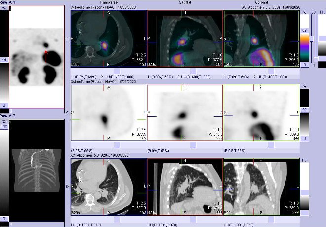 Obr. č. 8: Fúze obrazů SPECT a CT – vyšetření 4 hod. po aplikaci radiofarmaka. Zaměřeno na ložisko v levé plíci.