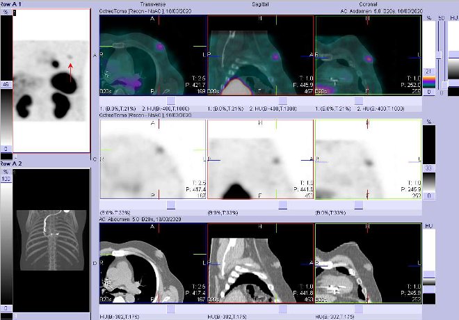 Obr. č. 9: Fúze obrazů SPECT a CT – vyšetření 4 hod. po aplikaci radiofarmaka. Zaměřeno na ložisko zřejmě v prsní žláze vlevo.