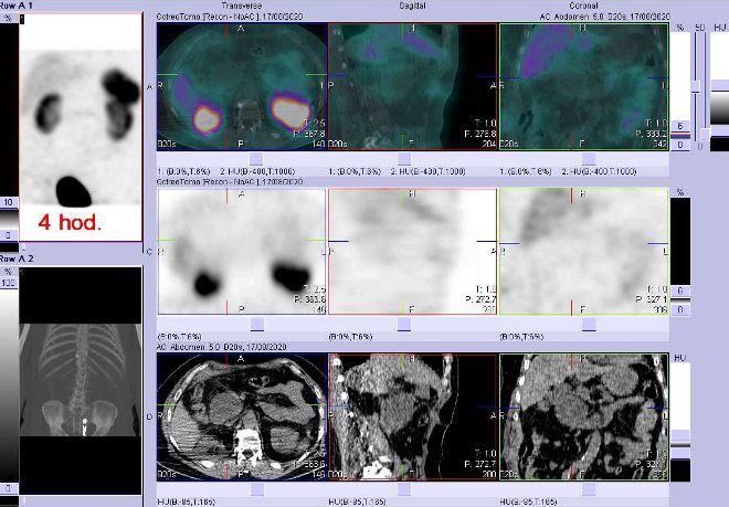 Obr. č. 2: Fúze obrazů SPECT a CT – vyšetření 4 hod. po aplikaci radiofarmaka. Zaměřeno na neakumulující ložisko pod hlavou pankreatu.
