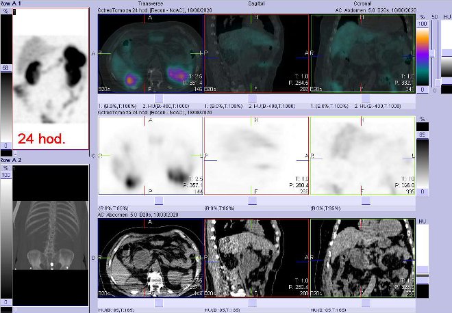 Obr. č. 3:Fúze obrazů SPECT a CT – vyšetření 24 hod. po aplikaci radiofarmaka. Zaměřeno na neakumulující ložisko pod hlavou pankreatu.