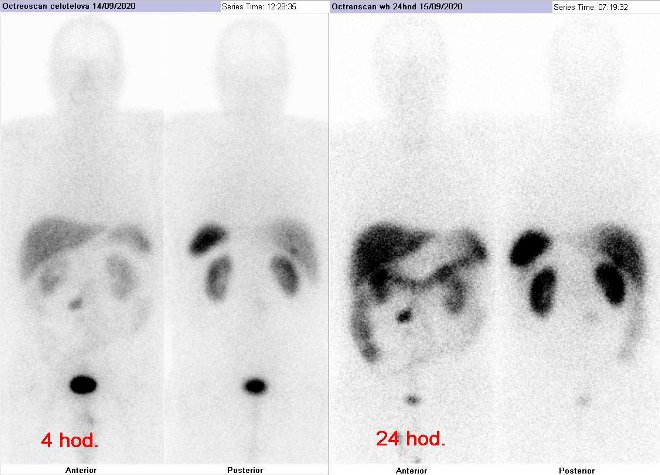 Obr.č.1: Celotělová scintigrafie v přední a zadní projekci. Vyšetření 4 hod. (vlevo) a 24 hod. (vpravo) po aplikaci radioindikátoru.
