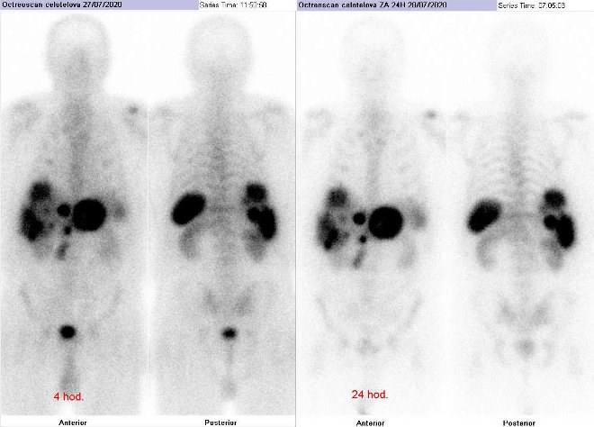 Obr. č. 1: Celotělová scintigrafie v přední a zadní projekci. Vyšetření 4 hod. (vlevo) a 24 hod. (vpravo) po aplikaci radioindikátoru.