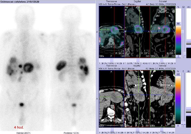 Obr. č. 2: Celotělová scintigrafie a fúze obrazů SPECT a CT – vyšetření 4 hod. po aplikaci radiofarmaka. Zaměřeno na velké ložisko v levém jaterním laloku.