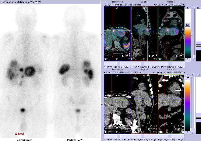 Obr. č. 3: Celotělová scintigrafie a fúze obrazů SPECT a CT – vyšetření 4 hod. po aplikaci radiofarmaka. Zaměřeno na ložisko ve ventrální části jater v blízkosti pomezí pravého a levého laloku.