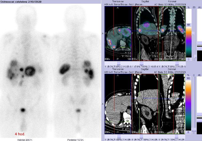 Obr. č. 4: Celotělová scintigrafie a fúze obrazů SPECT a CT – vyšetření 4 hod. po aplikaci radiofarmaka. Zaměřeno na ložisko v dorzální části pravého jaterního laloku.