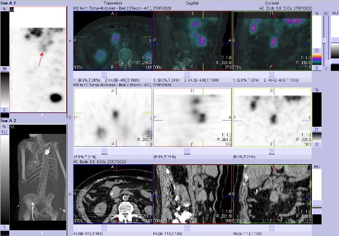 Obr. č. 5: Fúze obrazů SPECT a CT – vyšetření 4 hod. po aplikaci radiofarmaka. Zaměřeno na uzlinu periportální.