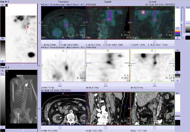 Obr. č. 6: Fúze obrazů SPECT a CT – vyšetření 4 hod. po aplikaci radiofarmaka. Zaměřeno na uzlinu periportální.