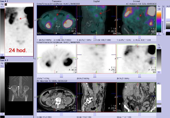Obr.3: Fúze obrazů SPECT a CT – vyšetření 24 hod. po aplikaci radiofarmaka. Zaměřeno na ložisko v oblasti hlavy pankreatu.