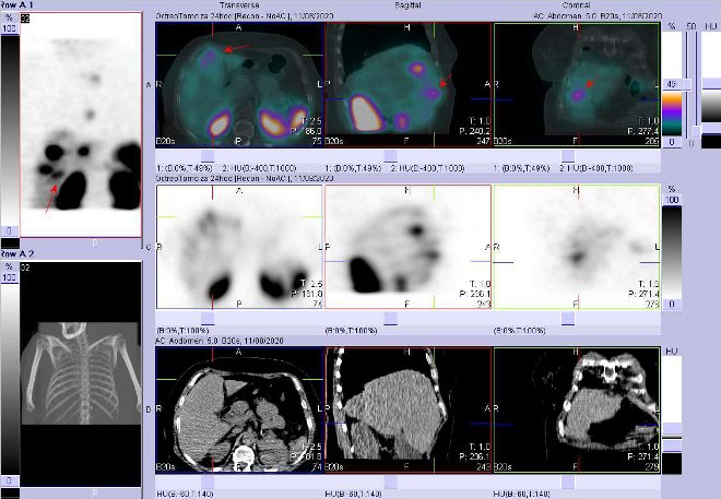 Obr. č. 13: Fúze SPECT/CT hrudníku a proximální části břicha 24 hod. po aplikaci OctreoScanu. Zaměřeno na ložisko v pravém jaterním laloku.