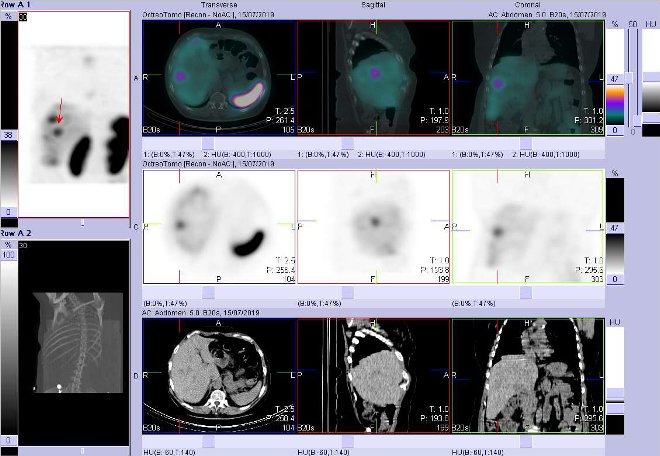 Obr.č.2: Fúze SPECT/CT hrudníku a proximální části břicha 4 hod. po aplikaci OctreoScanu. Zaměřeno na ložisko v pravém jaterním laloku.