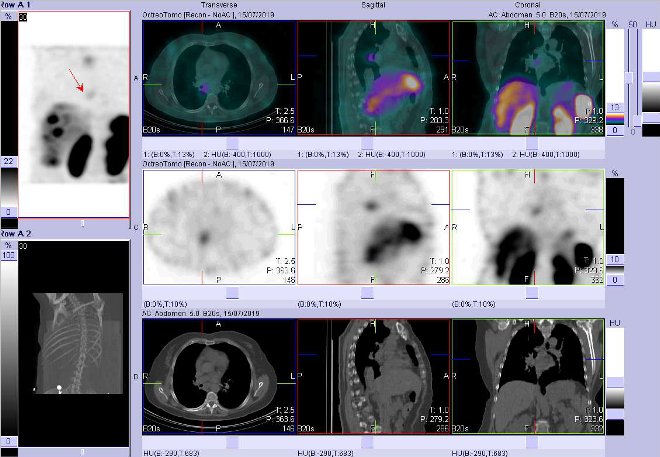 Obr.3: Fúze SPECT/CT hrudníku a proximální části břicha 4 hod. po aplikaci OctreoScanu. Zaměřeno na ložisko v mediastinu vpravo.