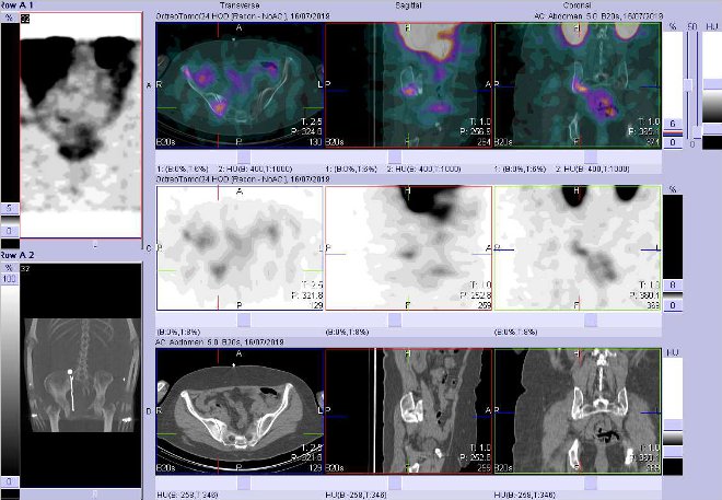 Obr. č. 5: Fúze SPECT/CT břicha a pánve 24 hod. po aplikaci OctreoScanu. Zaměřeno na ložisko v pánvi v kosti kyčelní v blízkosti pravého SI skloubení.