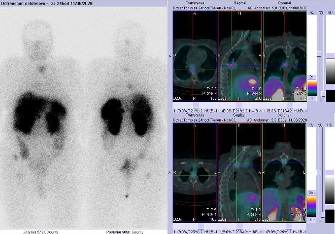 Obr. č. 7: Celotělová scintigrafie a fúze SPECT/CT krku, hrudníku a proximální části břicha 24 hod. po aplikaci OctreoScanu. Zaměřeno na ložisko v mediastinu vpravo a v obratli Th1.