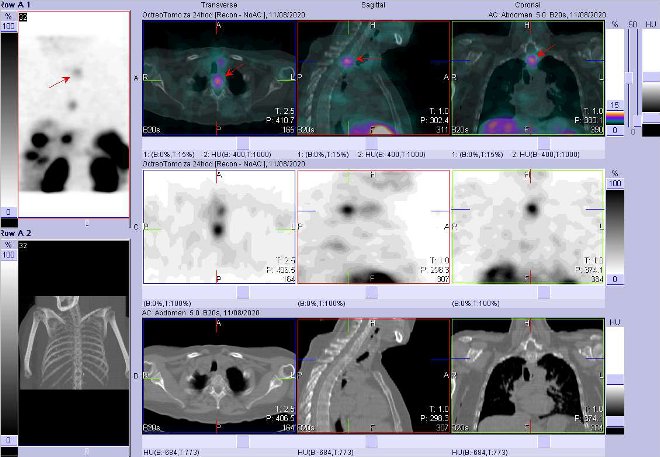Obr. č. 8: Fúze SPECT/CT krku, hrudníku a proximální části břicha 24 hod. po aplikaci OctreoScanu. Zaměřeno na ložisko v obratli Th1.