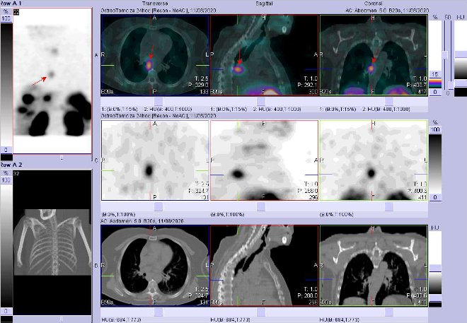 Obr. č. 9: Fúze SPECT/CT krku, hrudníku a proximální části břicha 24 hod. po aplikaci OctreoScanu. Zaměřeno na ložisko v mediastinu vpravo.