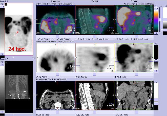 Obr. č. 10: Fúze obrazů SPECT a CT – vyšetření břicha a části pánve 24 hod. po aplikaci radiofarmaka. Zaměřeno na ložisko v pravém mesogastriu.