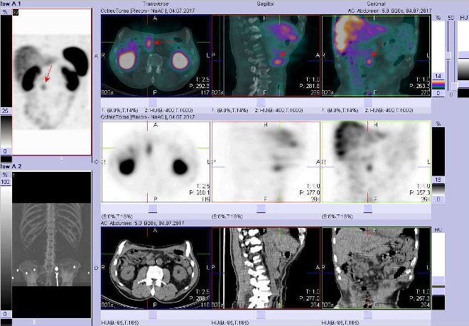 Obr.č.2: Fúze obrazů SPECT a CT – vyšetření břicha a části pánve 4 hod. po aplikaci radiofarmaka. Zaměřeno na ložisko v pravém mesogastriu.
