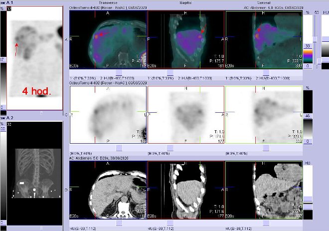 Obr. č. 4:Fúze obrazů SPECT a CT – vyšetření břicha a části pánve 24 hod. po aplikaci radiofarmaka. Zaměřeno na ložisko v pravém jaterním laloku.