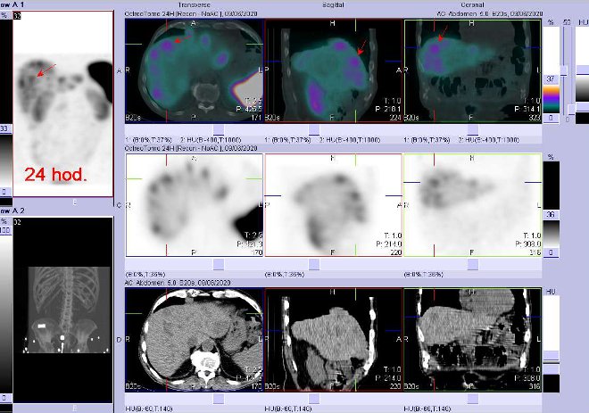 Obr. č. 5: Fúze obrazů SPECT a CT – vyšetření břicha a části pánve 24 hod. po aplikaci radiofarmaka. Zaměřeno na ložisko v pravém jaterním laloku.