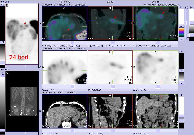 Obr. č. 8: Fúze obrazů SPECT a CT – vyšetření břicha a části pánve 24 hod. po aplikaci radiofarmaka. Zaměřeno na ložisko v levém jaterním laloku.