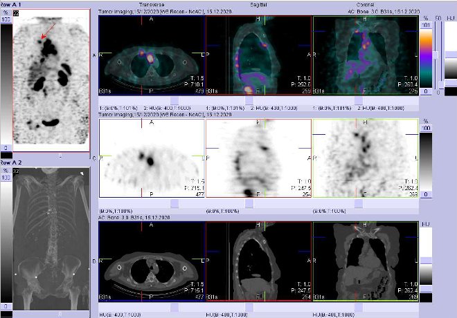 Obr. č. 9: Fúze SPECT/CT 24 hod. po aplikaci OctreoScanu. Zaměřeno na ložisko u 2. žebra vpravo ventrálně.