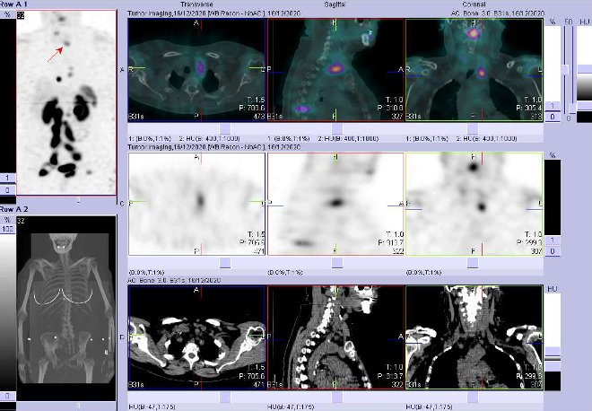 Obr.3: Fúze SPECT/CT 4 hod. po aplikaci OctreoScanu. Zaměřeno na ložisko v krční uzlině vlevo.