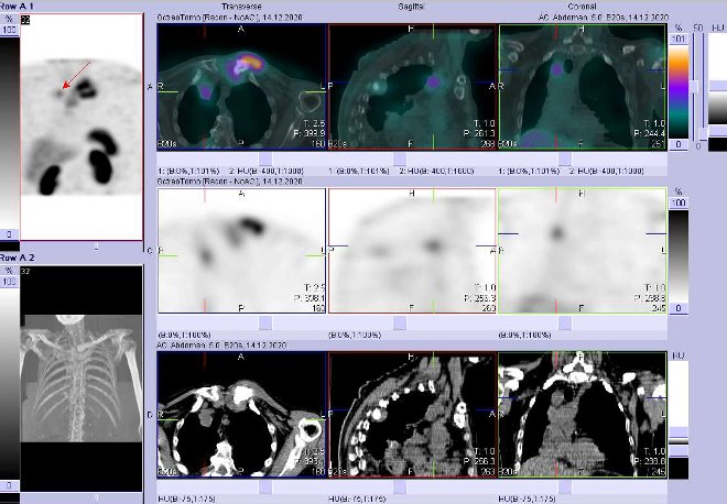 Obr. č. 3: Fúze SPECT/CT hrudníku 4 hod. po aplikaci OctreoScanu. Zaměřeno na ložisko ve ventrokraniální části pravé plíce.