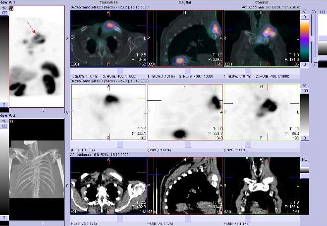 Obr. č. 8: Fúze SPECT/CT hrudníku 24 hod. po aplikaci OctreoScanu. Zaměřeno na ložisko v levé klíční kosti a jejím okolí.