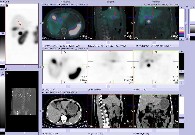 Obr. č. 3: Fúze SPECT/CT břicha a pánve 24 hod. po aplikaci OctreoScanu. Zaměřeno na ložisko v žaludku na přechodu antra a pyloru. Dvojí modulace obrazu.