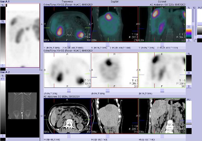 Obr. č. 4: Fúze obrazů SPECT a CT – vyšetření 4 hod. po aplikaci radiofarmaka. Zaměřeno na ložisko v kaudální části pravého jaterního laloku bez zvýšené akumulace radiofarmaka, dle CT hypodenzní.
