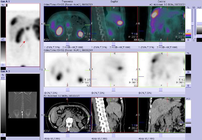 Obr. č. 5: Fúze obrazů SPECT a CT – vyšetření 4 hod. po aplikaci radiofarmaka. Zaměřeno na ložisko v břiše aortokaválně v úrovni L2-L3.