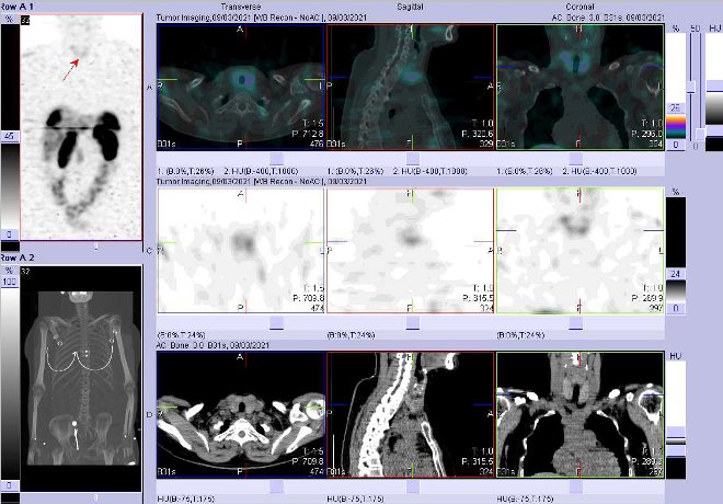 Obr. č. 6: Fúze obrazů SPECT a CT – vyšetření 24 hod. po aplikaci radiofarmaka. Mírná akumulace radioindikátoru v lalocích štítné žlázy.