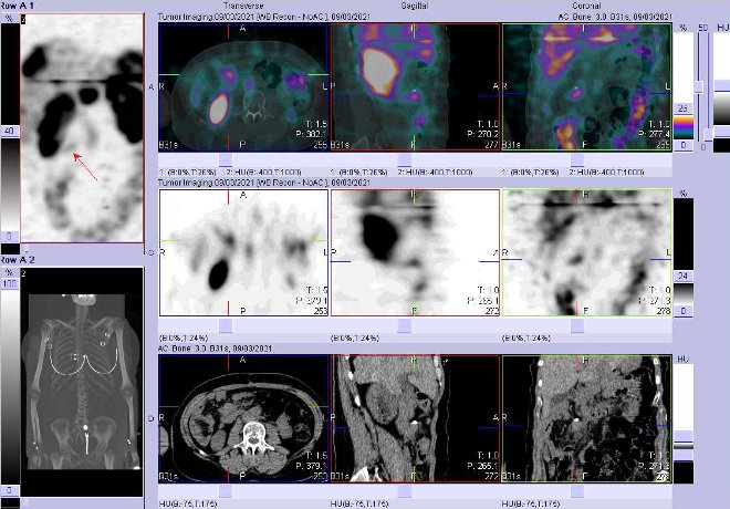 Obr. č. 7: Fúze obrazů SPECT a CT – vyšetření 24 hod. po aplikaci radiofarmaka. Zaměřeno na ložisko mesenteriálně v pravém mezogastriu.
