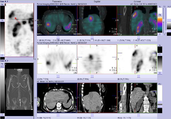 Obr. č. 8: Fúze obrazů SPECT a CT – vyšetření 24 hod. po aplikaci radiofarmaka. Zaměřeno na ložisko v kraniolaterální části pravého jaterního laloku.