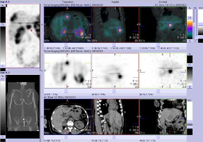 Obr. č. 9: Fúze obrazů SPECT a CT – vyšetření 24 hod. po aplikaci radiofarmaka. Zaměřeno na ložisko v levém jaterním laloku.