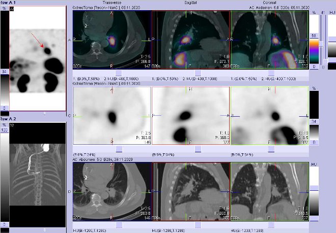 Obr. č. 10: Fúze obrazů SPECT a CT – vyšetření 4 hod. po aplikaci radiofarmaka. Zaměřeno na ložisko v levé plíci.