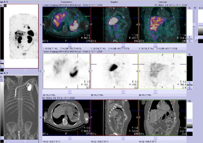 Obr. č. 11: Fúze obrazů SPECT a CT – vyšetření 24 hod. po aplikaci radiofarmaka. Zaměřeno na ložisko ve ventrální části jednoho žebra vlevo.