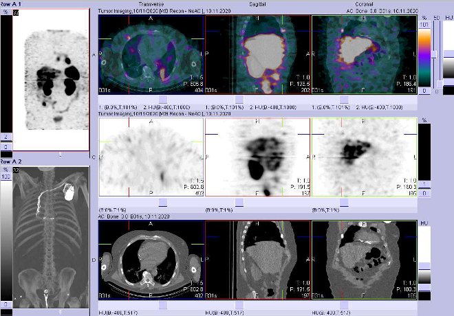 Obr. č. 12: Fúze obrazů SPECT a CT – vyšetření 24 hod. po aplikaci radiofarmaka. Zaměřeno na ložisko ve ventrální části jednoho žebra vpravo.