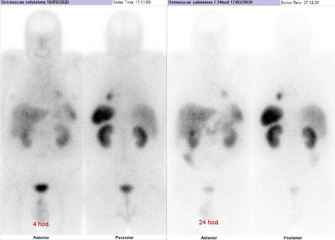 Obr.č.2: Celotělová scintigrafie v přední a zadní projekci. Vyšetření 4 hod. (vlevo) a 24 hod. (vpravo) po aplikaci radioindikátoru.
