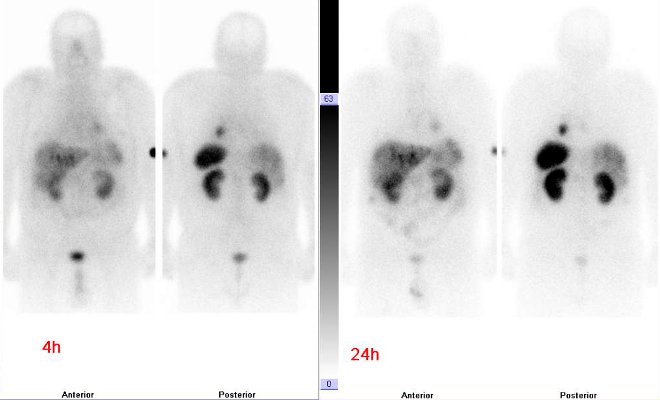 Obr.3: Celotělová scintigrafie v přední a zadní projekci. Vyšetření 4 hod. (vlevo) a 24 hod. (vpravo) po aplikaci radioindikátoru.