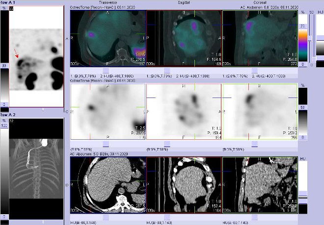 Obr. č. 5: Fúze obrazů SPECT a CT – vyšetření 4 hod. po aplikaci radiofarmaka. Zaměřeno na ložisko v pravém jaterním laloku.