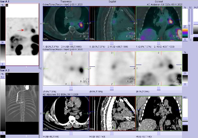 Obr. č. 6: Fúze obrazů SPECT a CT – vyšetření 4 hod. po aplikaci radiofarmaka. Zaměřeno na uzlinu pod bifurkací trachey.