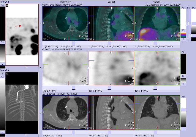 Obr. č. 7: Fúze obrazů SPECT a CT – vyšetření 4 hod. po aplikaci radiofarmaka. Zaměřeno na uzlinu v mediastinu paratracheálně vpravo.